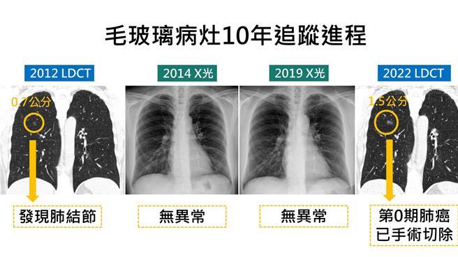 肺结节10年病灶演变肺癌进程图示。（门诺医院提供／王志伟花莲传真）