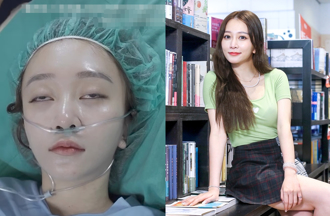 篠崎泫親公開手術前影片「眼歪嘴斜」狀態超失控