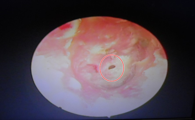 婦人的右耳遭蟑螂入侵後，耳膜破了一個洞（紅圈處）。圖／李瑞文醫師提供