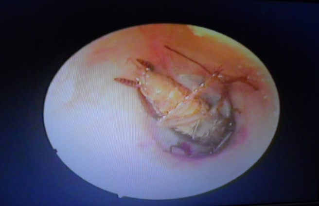 婦人覺得右耳悶塞難耐就醫，醫師檢查發現她的右耳裡躲著一隻大蟑螂。圖／李瑞文醫師提供