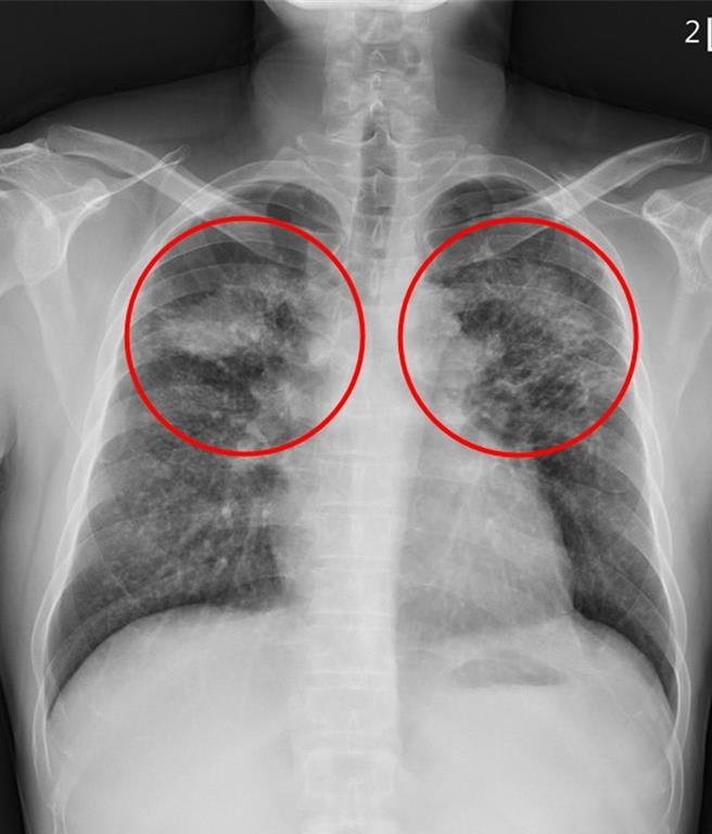花蓮一名黃先生年輕時曾有近10年的磨石工作經驗，後雖離開該行業，未料44歲自影像檢查中發現肺部有大塊陰影，確診塵肺症導致的肺部纖維化，醫師表示，矽肺症不可逆，沒有特效藥，呼籲從事石材工作者務必使用工業級防護口罩或面罩。（花蓮慈濟醫院提供／羅亦晽花蓮傳真）