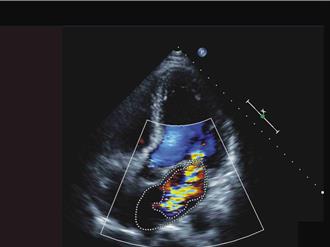 不是感冒！ 6旬果農高燒、心臟有雜音 竟染心內膜炎敗血還化膿