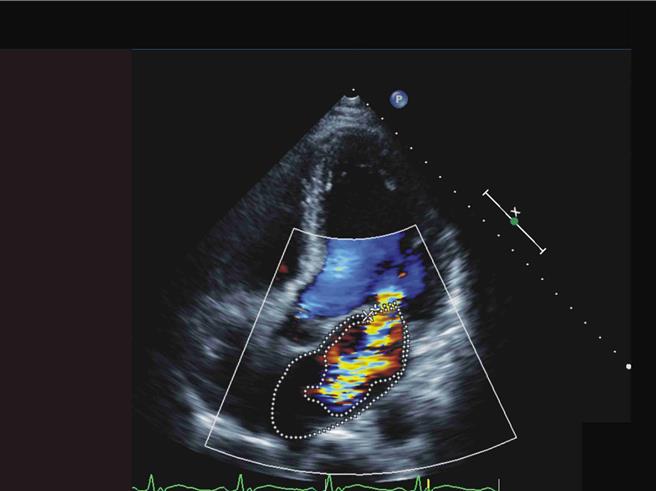 心臟超音波顯示，陳姓果農的二尖瓣受損，造成血液嚴重回流。（彰化基督教醫院提供／孫英哲彰化傳真）