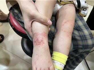 冬天腸病毒罕見活躍 台中1女童確診「重症大魔王」