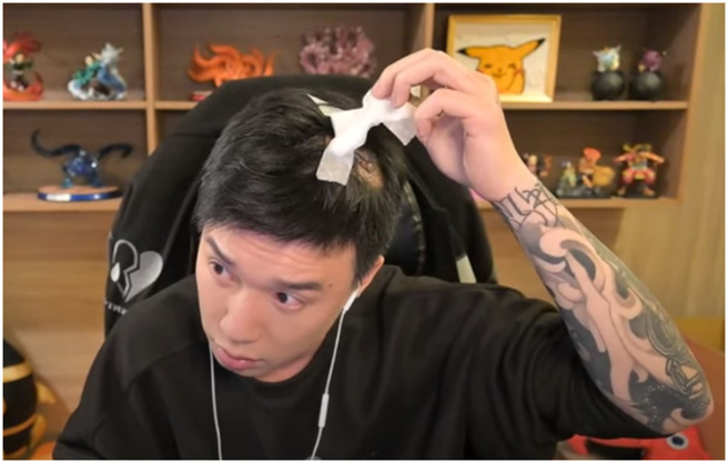 Toyz公开伤势，说有可能会变秃头。（图／摘自Toyz YouTube）