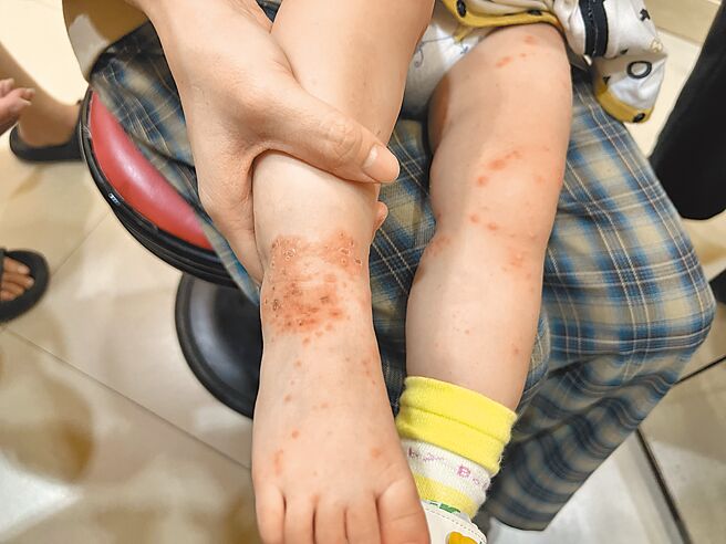 台中儿科门诊近来遇到多例婴幼儿感染肠病毒，四肢出现水泡与疹子，症状比以往肠病毒感染严重，不少家长也同时被感染。（医师施胜桓提供／王煌忠台中传真）