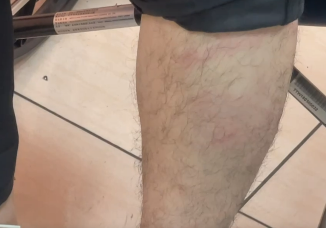 林炜轩当街遭殴，小腿红肿处相当明显。(戴志扬翻摄)