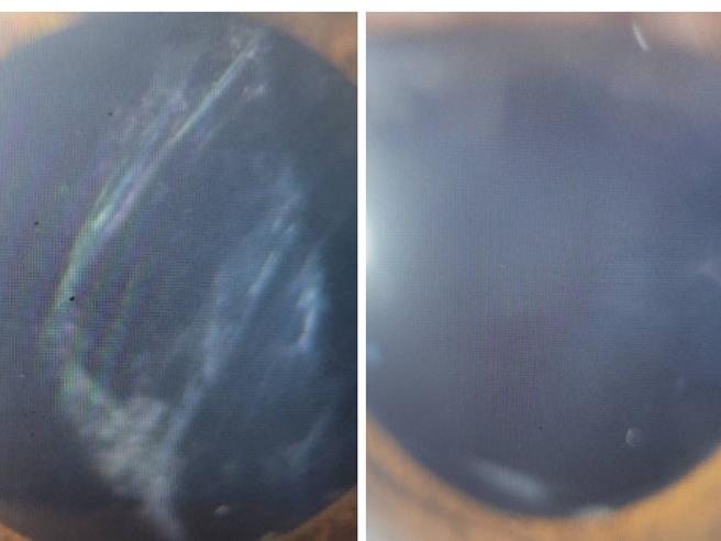 高雄一名患者進行白內障手術後，出現「後白內障」，因狀似台灣島（左），讓治療的醫師嘖嘖稱奇，所幸經雷射治療後已恢復視力（右）。（達特楊眼科聯盟提供／任義宇高雄傳真）