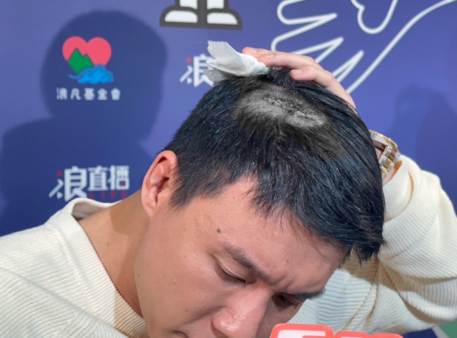 Toyz晒出头上伤口。（谢佩桦摄）