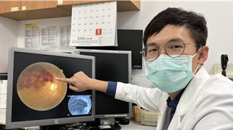 眼睛也會中風！ 5旬婦起床竟模糊看不清