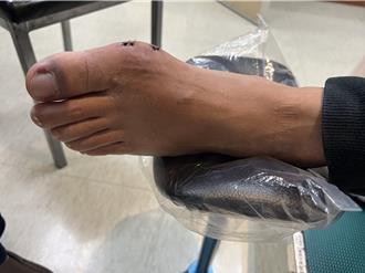 超音波刀震碎痛風石 微創手術告別疼痛