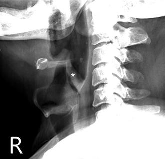 53歲翁流口水、吞嚥困難 罪魁禍首竟是「這玩意兒」
