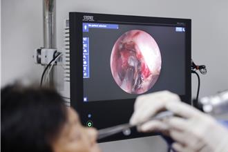 8旬嬤頭痛欲裂「鼻竇黴菌」是禍首 3D導航精準去病灶