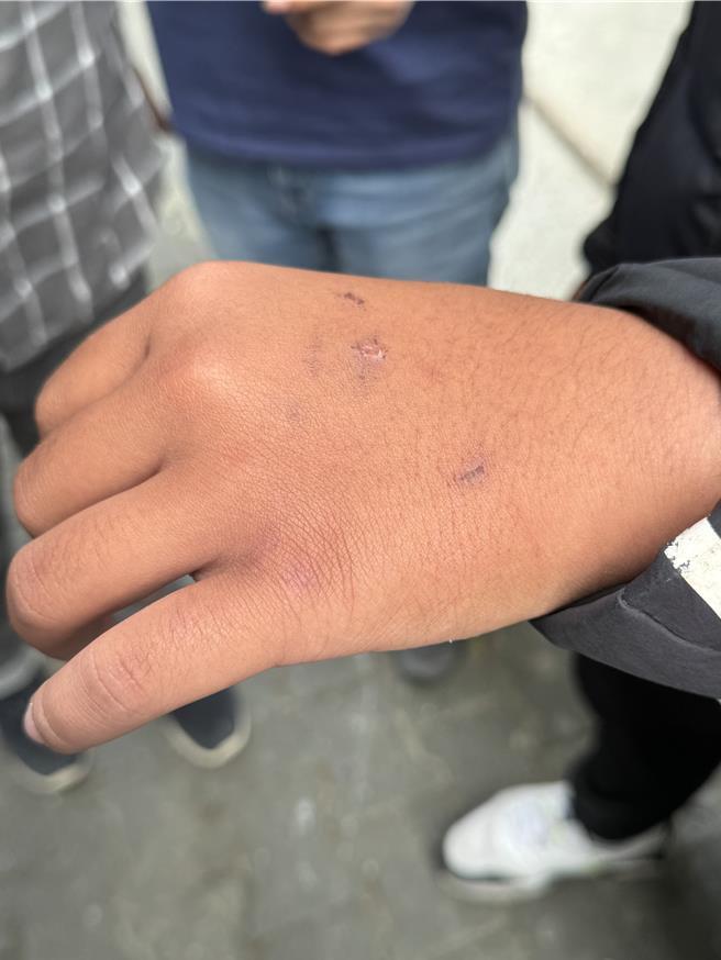 叶姓少年出示手部遭电击棒的痕迹。(曹婷婷摄)