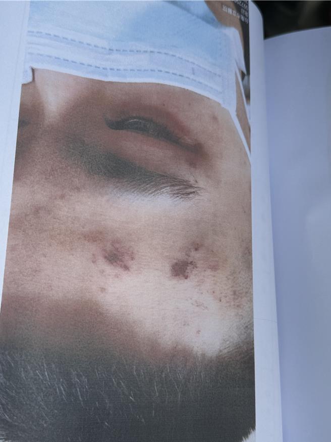 律师出示少年遭殴打的痕迹。(曹婷婷摄)