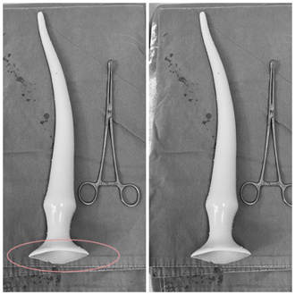 獨》男菊花有吸盤 醫取出50cm柱狀物 曝最慘下場