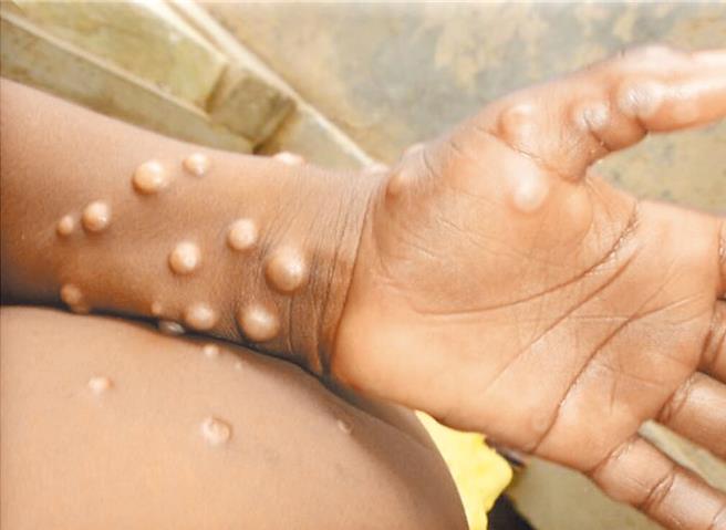 中國醫學科學院、中國科學院等近日發布一項最新研究成果，在全世界首次揭示猴痘病毒DNA複製的工作機制。（翻攝自世界衛生組織）