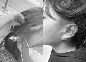 16歲妹妹遭沖天炮炸耳！哥心疼「耳膜破裂」 PO網尋目擊者緝凶