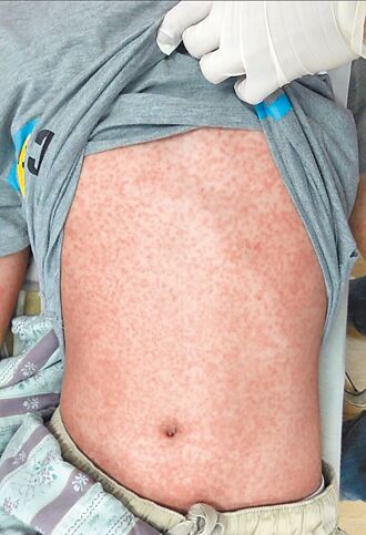 今年首例本土麻疹 感染源不明