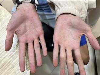 肠病毒变异了！医曝罕见跨世代群聚 7岁到50岁都中镖