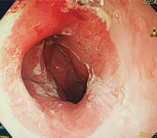 經胸腔外科醫師手術後，邱先生順利恢復。（大千醫院提供／李京昇苗栗傳真）