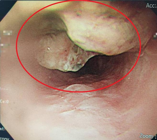 邱先生經胃鏡檢查，發現有惡性腫瘤(紅圈處)，確診為食道癌。（大千醫院提供／李京昇苗栗傳真）