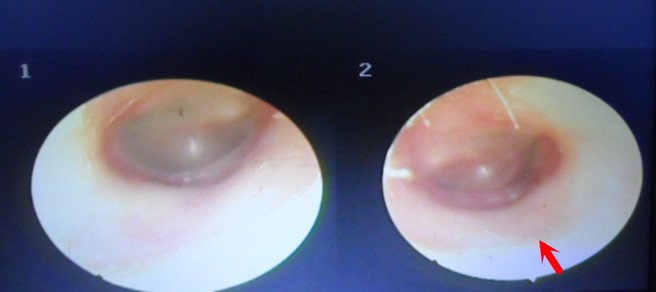 在内视镜检查中，可看到少年的左耳外耳道红肿（箭头处），左侧图为少年右耳内视镜检查一切正常。（图／李瑞文医师提供）