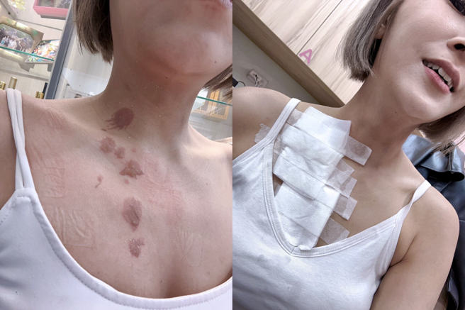 丢丢妹直播时遭热油烫伤。（楼顶揪楼下提供）