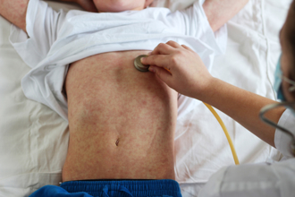 麻疹爆群聚！北部30多歲醫護被傳染 去過桃機、中和米粉湯