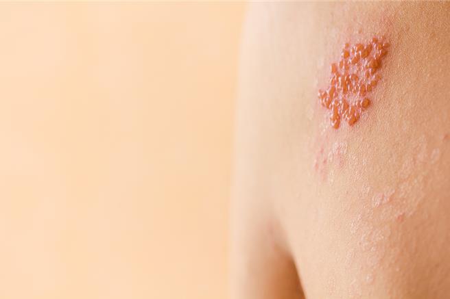 压力大、季节变化时容易诱发皮蛇，若自觉皮肤麻痛、感觉丧失，可能是神经痛的表现。（示意图／达志影像）