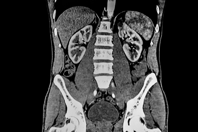印度一名男子为了健身，吞下79枚硬币和磁铁，结果腹痛20天，就医检查才发现小肠已经吸在一起。 (示意图:shutterstock/达志)