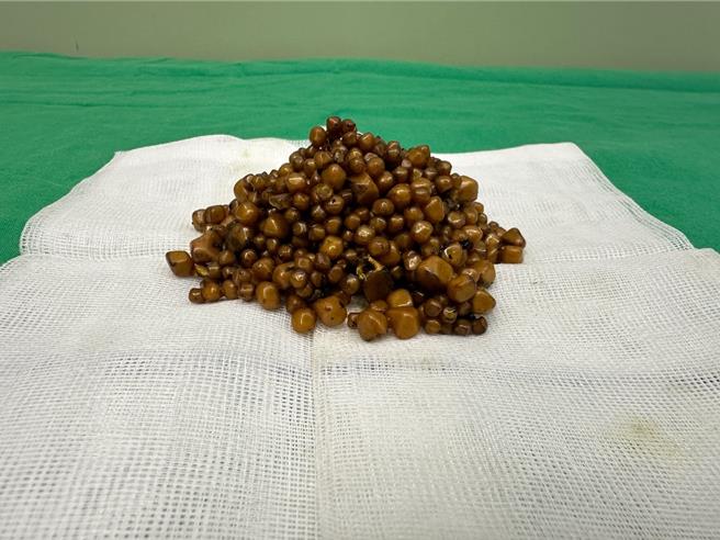 2024年2月29日新北市／新北九旬老翁年後開始右上腹及上腹疼痛，原以為是過年大魚大肉吃壞肚子，經醫院檢查發現膽囊腫脹且有結石。（新北市三峽恩主公醫院提供／劉瑋晴新北傳真）