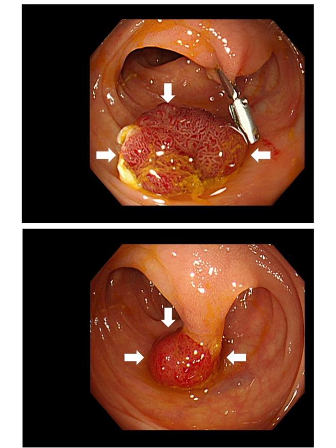 50岁陈先生日前接受大肠癌筛检，粪便潜血检验呈阳性，就医检查发现其大肠中有数颗瘜肉，幸採瘜肉切除术并将检体送验后发现是良性大肠腺瘤，定期追踪即可。（大里仁爱医院提供／潘虹恩台中传真）