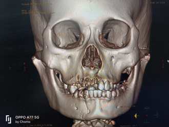 13歲少女「偷騎車撞電桿」慘破相！醫歎： 顏骨碎裂成拚圖