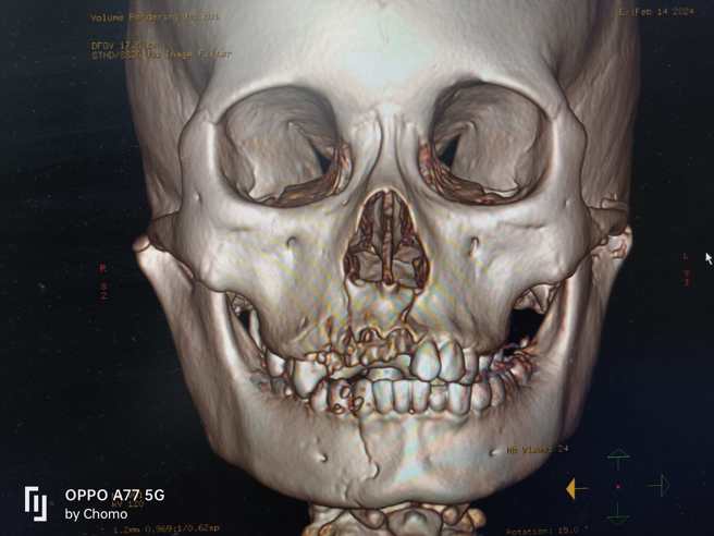 一名国中少女偷骑乘家里的机车溜出门，结果失控撞上电线杆，伤势严重。（图／翻摄脸书「黑伦医师x健康谘询」）