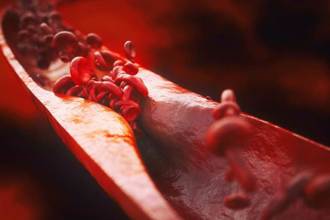 4兄弟有3人心血管阻塞 医追问揪出2关键：快检查