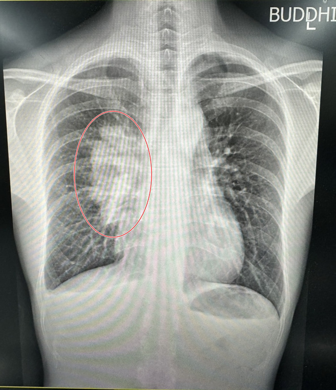 检查影像中，可看到男子纵膈腔处有一个拳头大般的肿瘤。（图／侯思任医师提供）