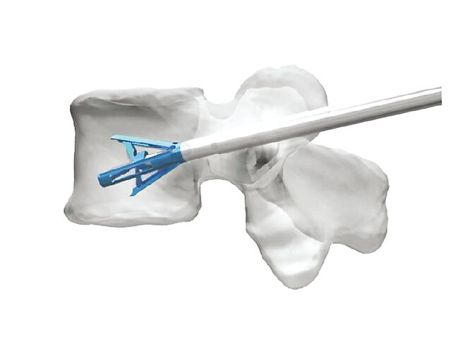 椎体撑开器（Tripod-Fix）已成功于欧盟上市销售。图／台微医提供