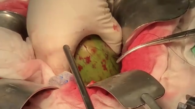 医生剖开男子的直肠「拔出」这颗椰子。（图／陈致一医师提供）