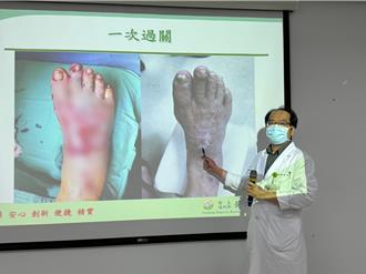 右腳遭車輾掀起整片皮 92歲嬤靠「雙壓治療」免植皮