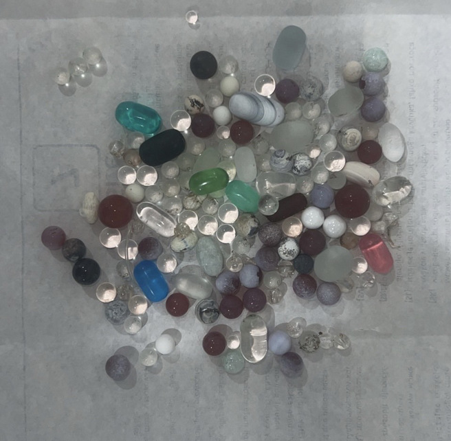 从刺青师阴茎上取出的入珠有大有小，图中部分珠子是从其它患者身上取下的。（图／李嘉文医师提供）