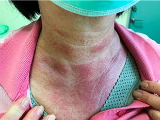 手臂關節處突冒紅疹 6旬婦人罹皮肌炎合併惡性腫瘤