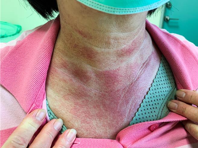 台中市罹患乳癌60歲黃姓婦人，開刀切除右乳追蹤1年後，脖子竟莫名出現紅疹，檢查發現是乳癌引起的皮肌炎，所幸配合治療將腫瘤控制良好，皮肌炎產生的紅疹才通通消失。（烏日林新醫院提供／王煌忠台中傳真）