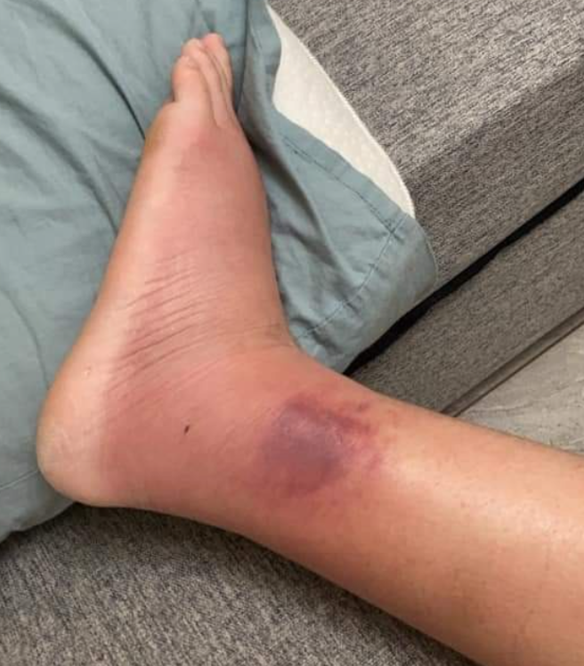 一名女网友日前因为脚部患有蜂窝性组织炎，行走相当不便，为此向外送员提出送餐上楼的需求，并称有电梯可直达住处，但却仍遭到对方拒绝，令她相当无奈。（图 / 翻摄自爆料公社）