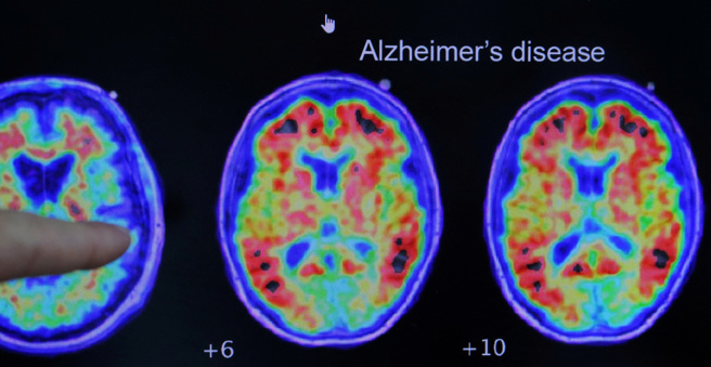 老年痴呆症會出現大腦蛋白斑塊堆積，之後大量神經亡凋亡。新研究從抑制酵素著手。(圖/路透社)