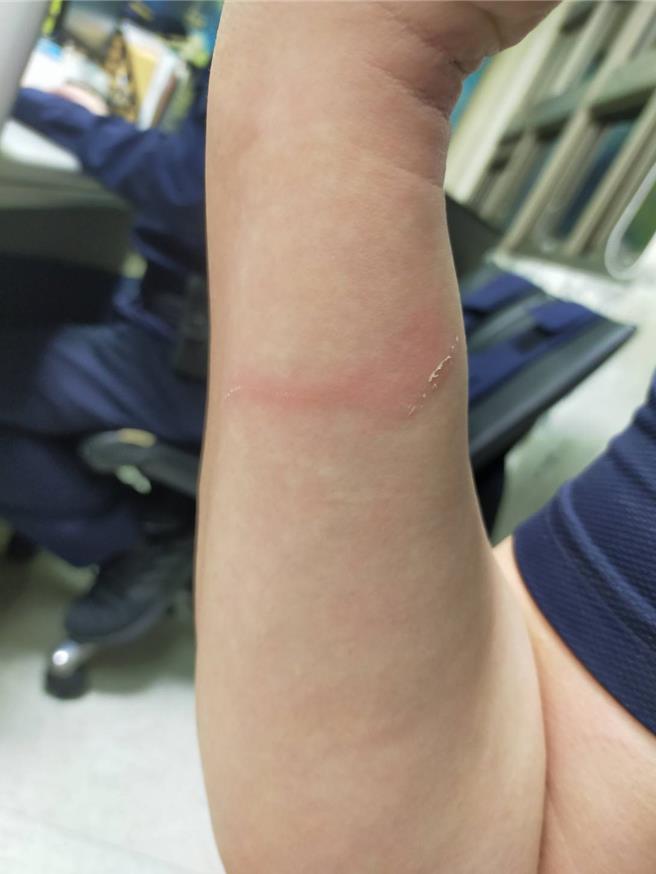 警員在拉扯過程中造成右手臂擦挫傷。（新北市淡水警分局提供／呂健豪新北傳真）