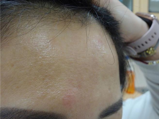 一名女性上班族长年有喝咖啡习惯，确诊COVID-19后，荨麻疹经常发作，经追踪才发现咖啡是过敏原。（大林慈济医院提供∕吕妍庭嘉义传真）