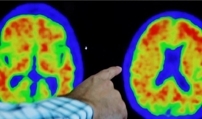 手机的APP将可用来检测早发性的失智症（路透社）