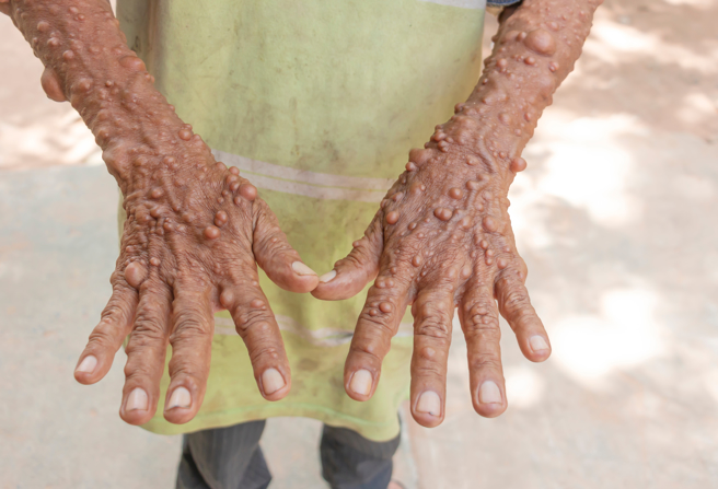 千里達及托巴哥一名女性罹患神經纖維瘤，全身長滿腫瘤，近日她接受手術「重獲新生」。（示意圖：Shutterstock／達志）