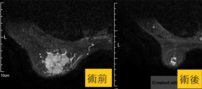 罹乳癌的50岁妇人经先化疗和标靶药物治疗，先缩小肿瘤，也保留乳房组织，疗程结束后，肿瘤的大小已经缩小到只有0.5公分。（长安医院提供／冯惠宜台中传真）